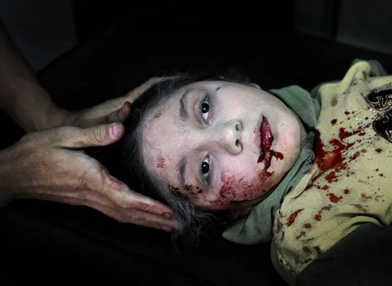 Una niña herida en Siria, la foto del año de UNICEF