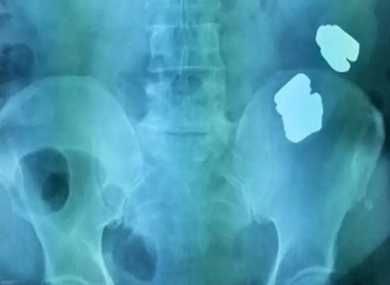 Inesperado hallazgo en el estómago de un hombre