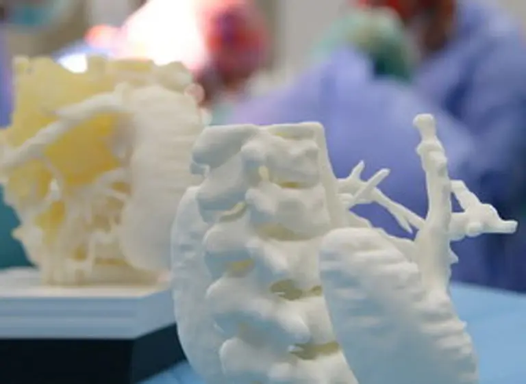 Extirpan un tumor en una operación compleja con una maqueta en 3D