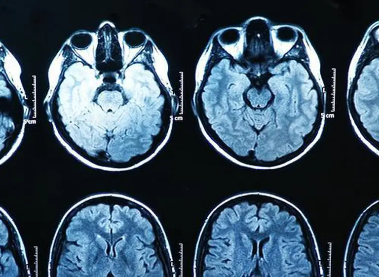 Sexo y ciencia: ¿cómo es el cerebro de los adictos al porno?