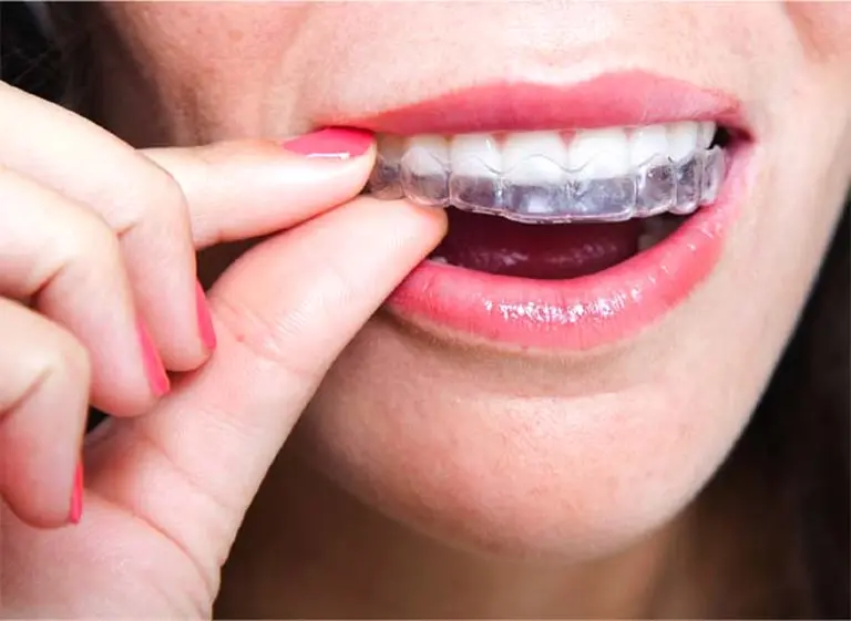 Ingenieros argentinos crean aparatos de ortodoncia invisibles con impresoras 3D