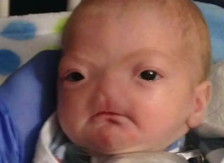La historia del bebé que nació sin nariz por rara enfermedad, da la vuelta al mundo