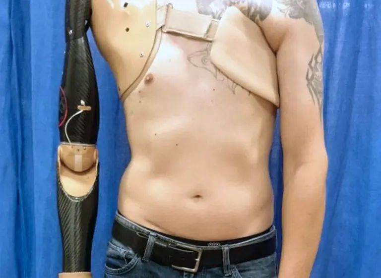Desarrollan un brazo protésico que detecta señales de la médula espinal