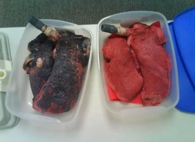 Impactante: así­ se hizo viral el video del pulmón de un fumador