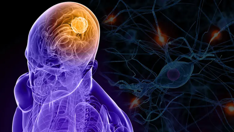 Estimulación vagal, un moderno tratamiento para la epilepsia refractaria