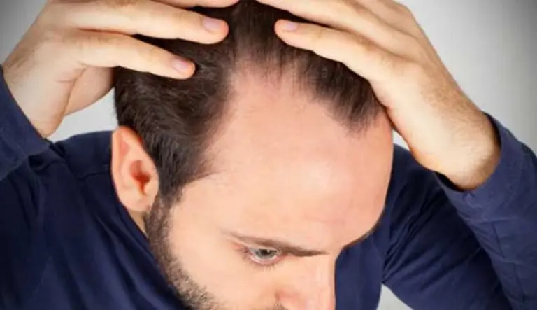 Tratamientos para la calvicie: mitos y verdades de un problema multifactorial