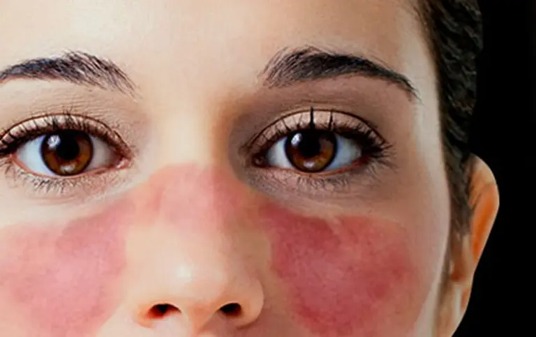 Lupus, ¿por qué es una enfermedad tan difícil de diagnosticar?