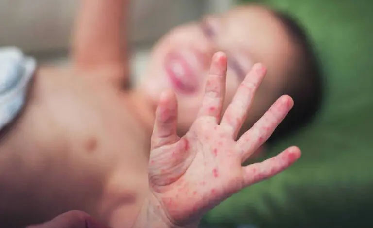 ¿Qué es el sarampión y cómo se puede contagiar la enfermedad?