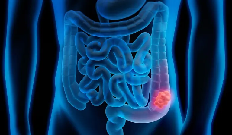 Cáncer de colon, ¿cuáles son los síntomas que pueden alertar de su presencia?