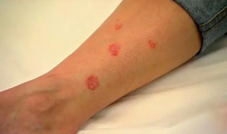 ¿Manchas rojas en la piel?: conocé las seis causas más frecuentes