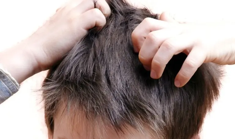 Calvario de padres: claves para evitar el contagio de piojos