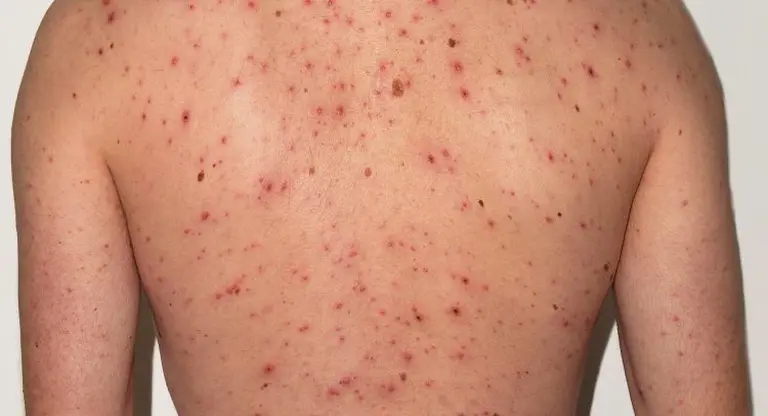 Alerta por sarampión: Salud confirmó un caso en un turista que estuvo en el país