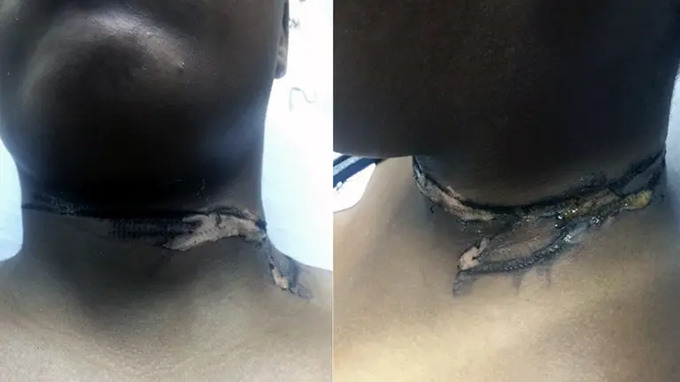 Mujer sufre impactantes quemaduras por descarga del cargador de un celular