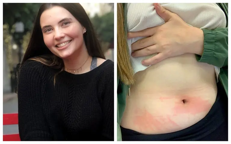 El insólito caso de una joven que es alérgica al agua y solo puede bañarse solo dos veces al mes