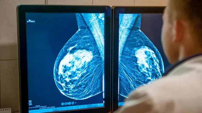 Esperanzador avance en cáncer de mama metastásico: una droga alcanzó sobrevida récord