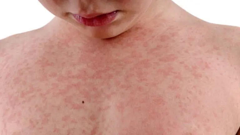 Escarlatina: qué la provoca y qué tan grave puede ser