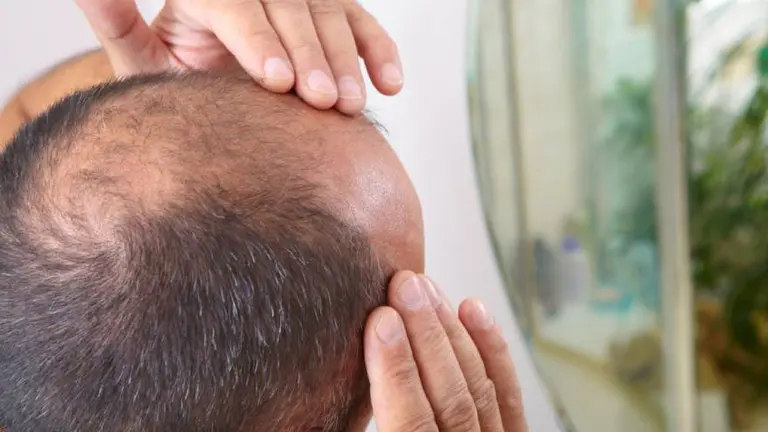 Estudio: esta sustancia natural podría ser la solución para la calvicie