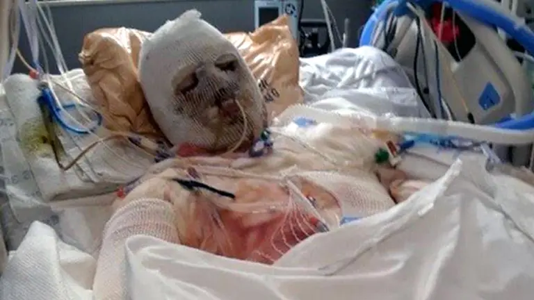 Mirá el primer trasplante del mundo de rostro y manos que le dio a este hombre una segunda oportunidad en la vida