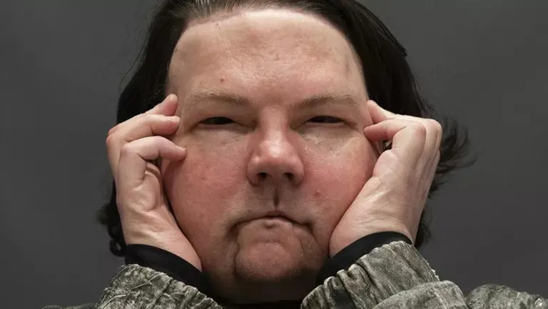 "Médicos asombrados": la increíble historia del primer trasplante simultáneo de rostro y manos