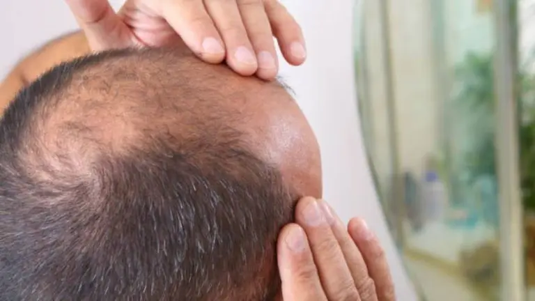 La hormona del estrés podría ser la causa de la calvicie: para los científicos, esta es la solución