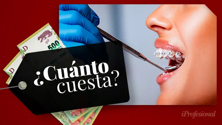 Cuánto cuesta ponerse brackets en Argentina 2021: todo lo que tenés que saber sobre los aparatos fijos