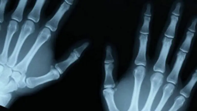 Innovación sin límites: así es la impresora que 3D "crea" huesos dentro del cuerpo de los pacientes