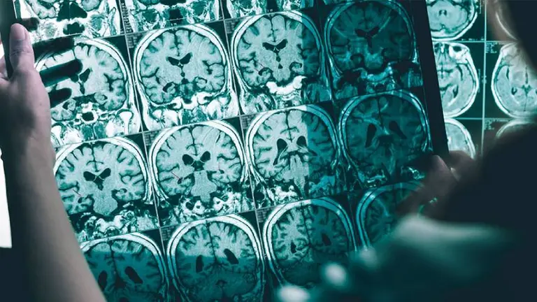 Aduhelm: cómo funciona el nuevo medicamento contra el Alzheimer aprobado en Estados Unidos