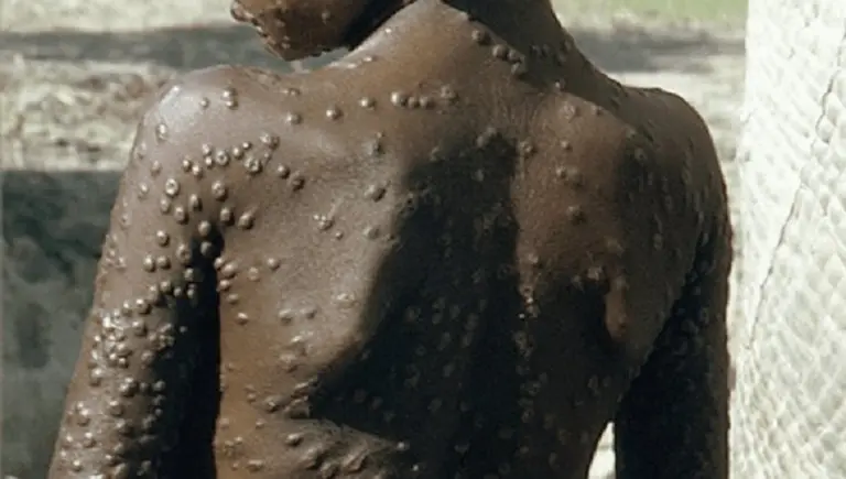 Viruela del mono: todo lo que hay que saber de la extraña enfermedad que preocupa a Europa y EE.UU.