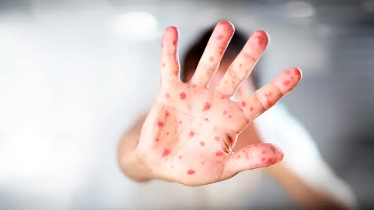 Viruela del mono: confirman el tercer caso del virus en la Argentina, el primero sin antecedentes de viaje