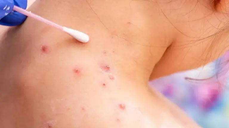 Viruela del mono, emergencia sanitaria global: qué vacunas y tratamientos se están usando