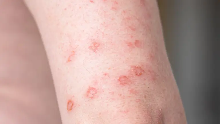 Aumento de casos de sífilis: qué es y cómo se transmite