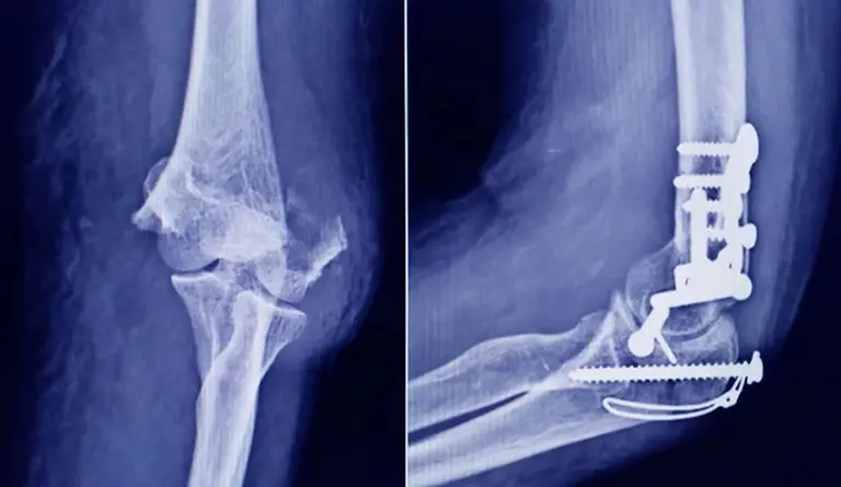 Cirugías en riesgo: ANMAT detectó un tornillo médico falso durante un control sanitario en Tucumán