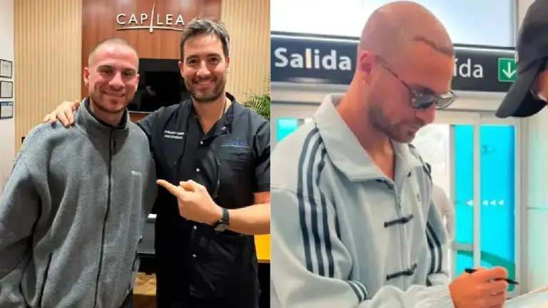 Foto partida al medio donde se lo ve al jugador de la Selección argentina Alexis Mac Allister post trataiemto capilar (foto enviada por la empresa)