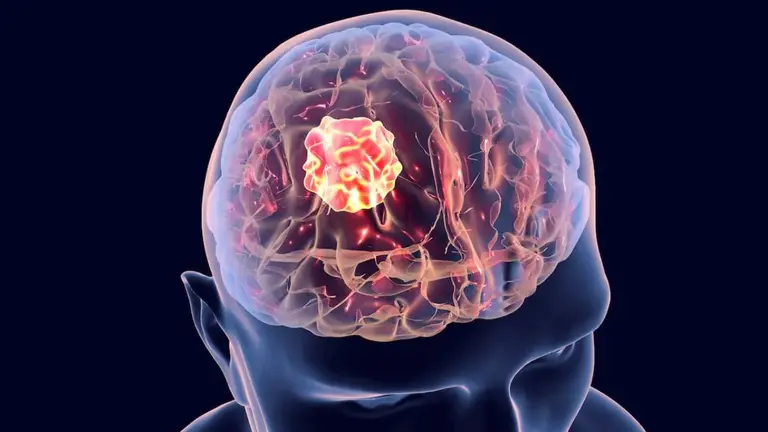 Glioblastoma, una enfermedad poco frecuente, agresiva y de enorme impacto clínico, humano y científico