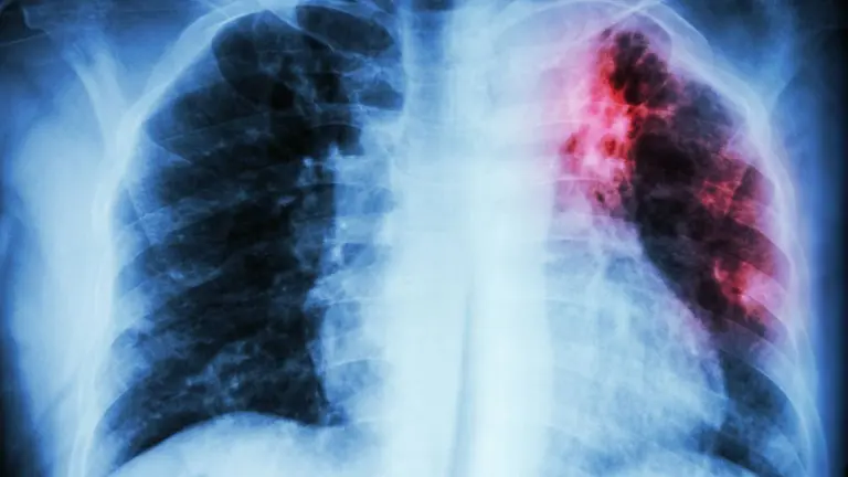 imagen de una placa de pulmones con fibrosis pulmonar