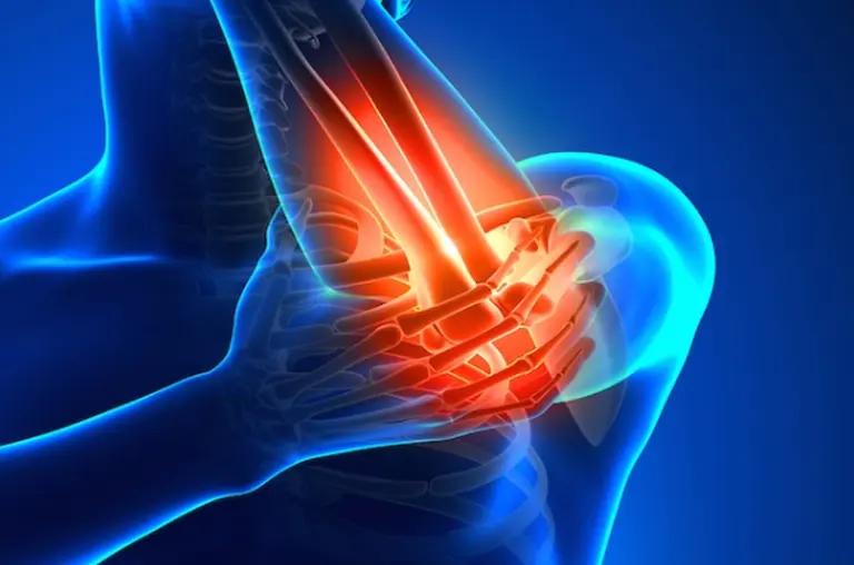 El juego de las diferencias: el codo de tenista vs el codo de golfista