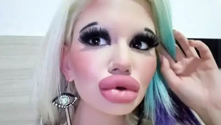 Fotos de antes y después del quirófano: se hizo 15 cirugías para triplicar el tamaño de sus labios