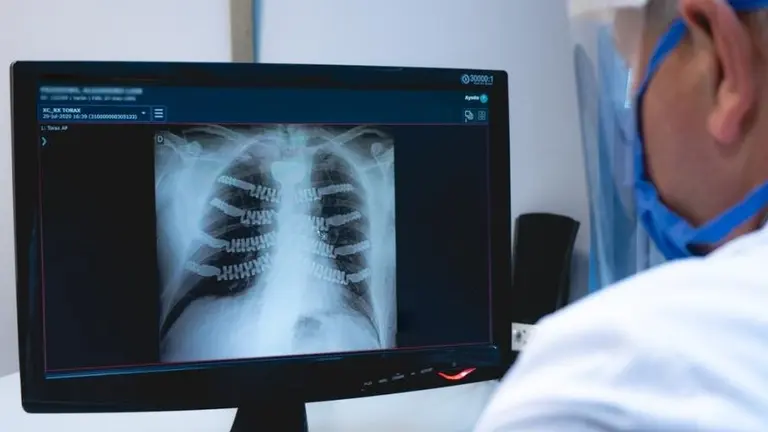 Médicos de Córdoba realizaron una reconstrucción torácica con prótesis 3D a medida: los detalles del proyecto