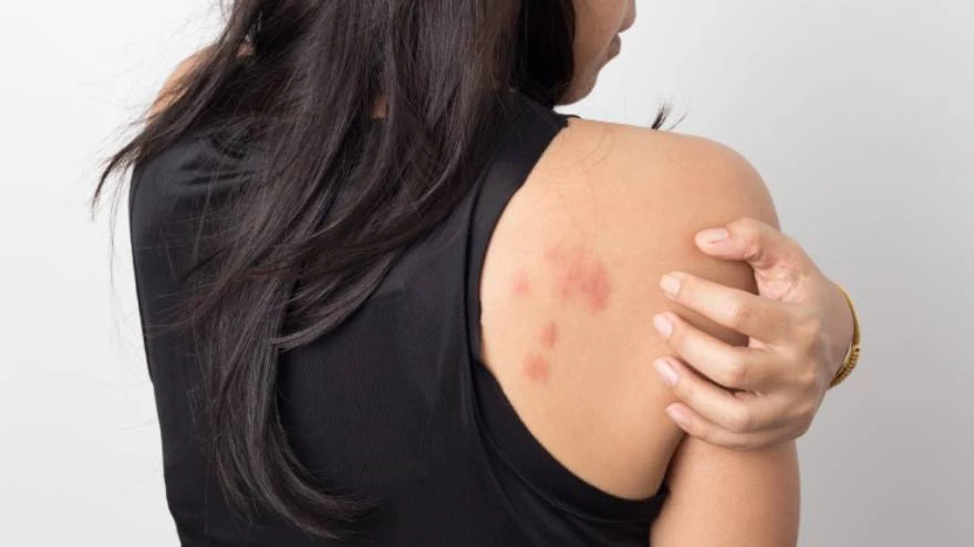 Privilegio piel en términos de Manchas ROJAS en la PIEL: las 6 causas más frecuentes