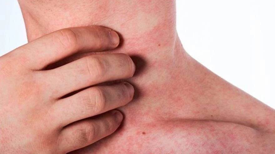 Chillido Asimilar Chicle Manchas rojas en la piel: causas de su aparición