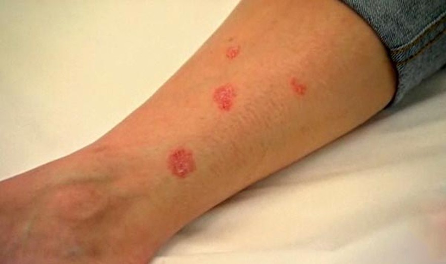 erupción cutánea con manchas de sangre en el brazo erupción cutánea con manchas de sangre en el brazo