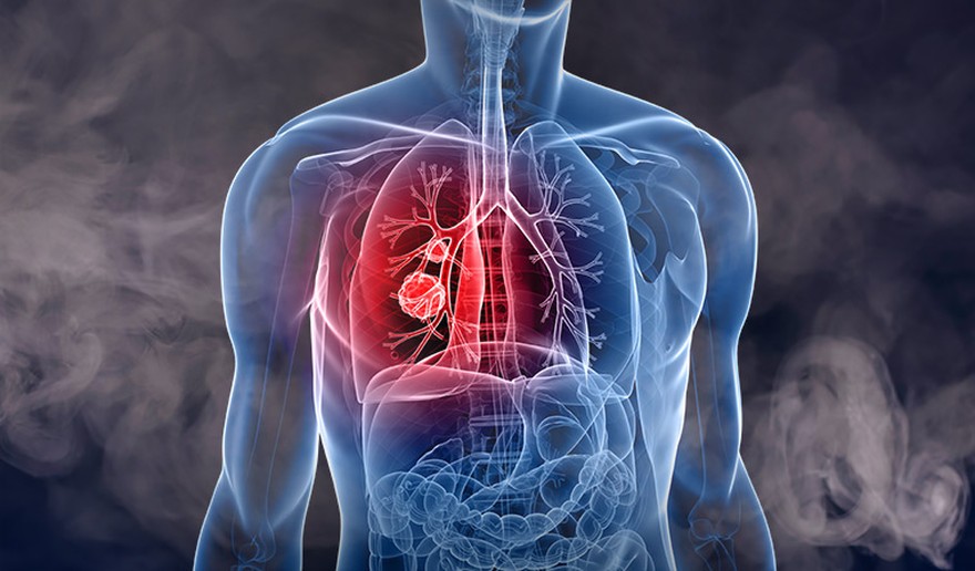 Una droga contra el cáncer de pulmón, sugerida para quedar fuera del PMO