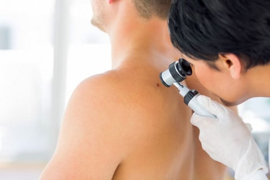 ABCDE: cómo darse cuenta si un lunar tiene riesgo de ser cancerígeno