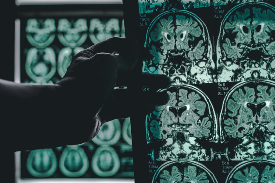 Una vacuna podría reducir el riesgo de padecer Alzheimer: cómo es y cuándo podría estar lista