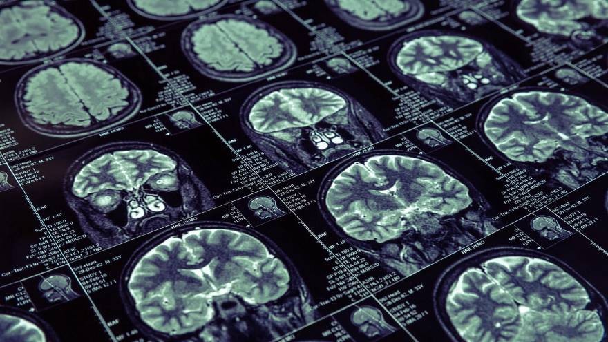 ¿Qué es un hematoma subdural y qué tratamiento requiere?