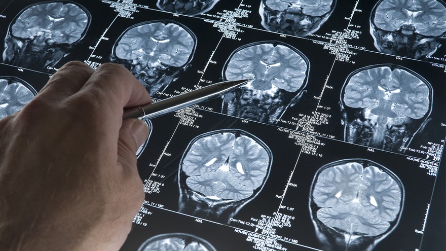 Inteligencia artificial para detectar tumores cerebrales: un algoritmo lo hace mediante el análisis de la sangre