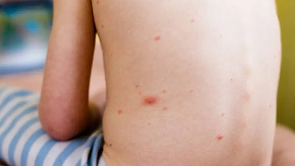 Urticaria