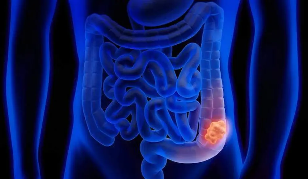 El estudio observó un riesgo creciente de cáncer de colon en quienes se trataron con antibióticos