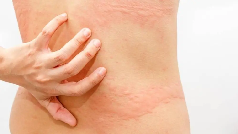 La urticaria es una de las causas de manchas rojas en la pielq