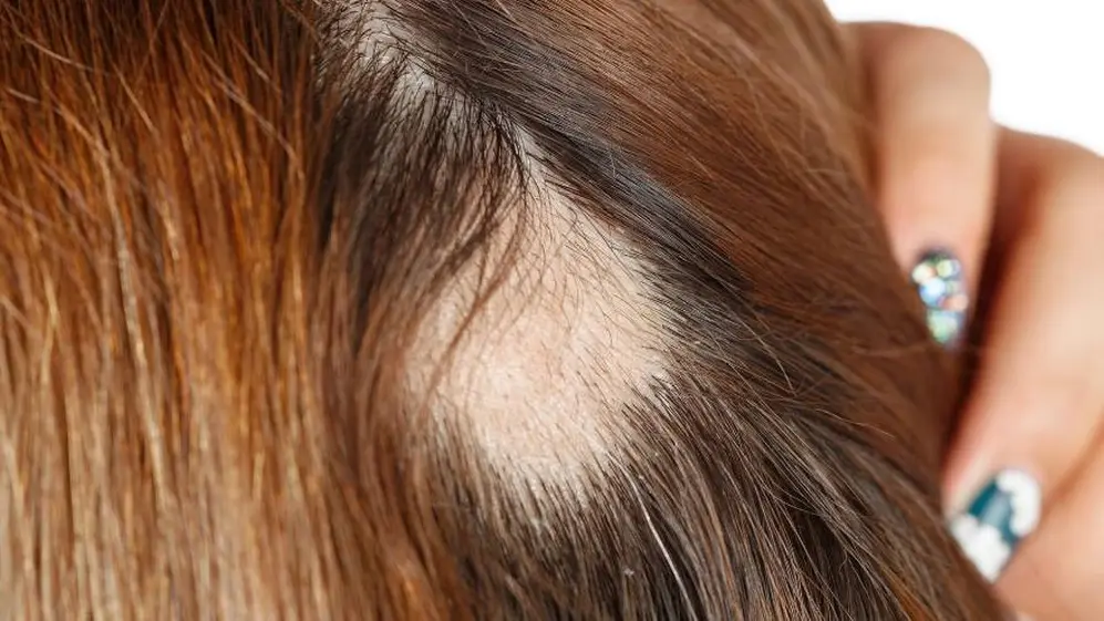 La alopecia androgénica también puede afectar a las mujeres